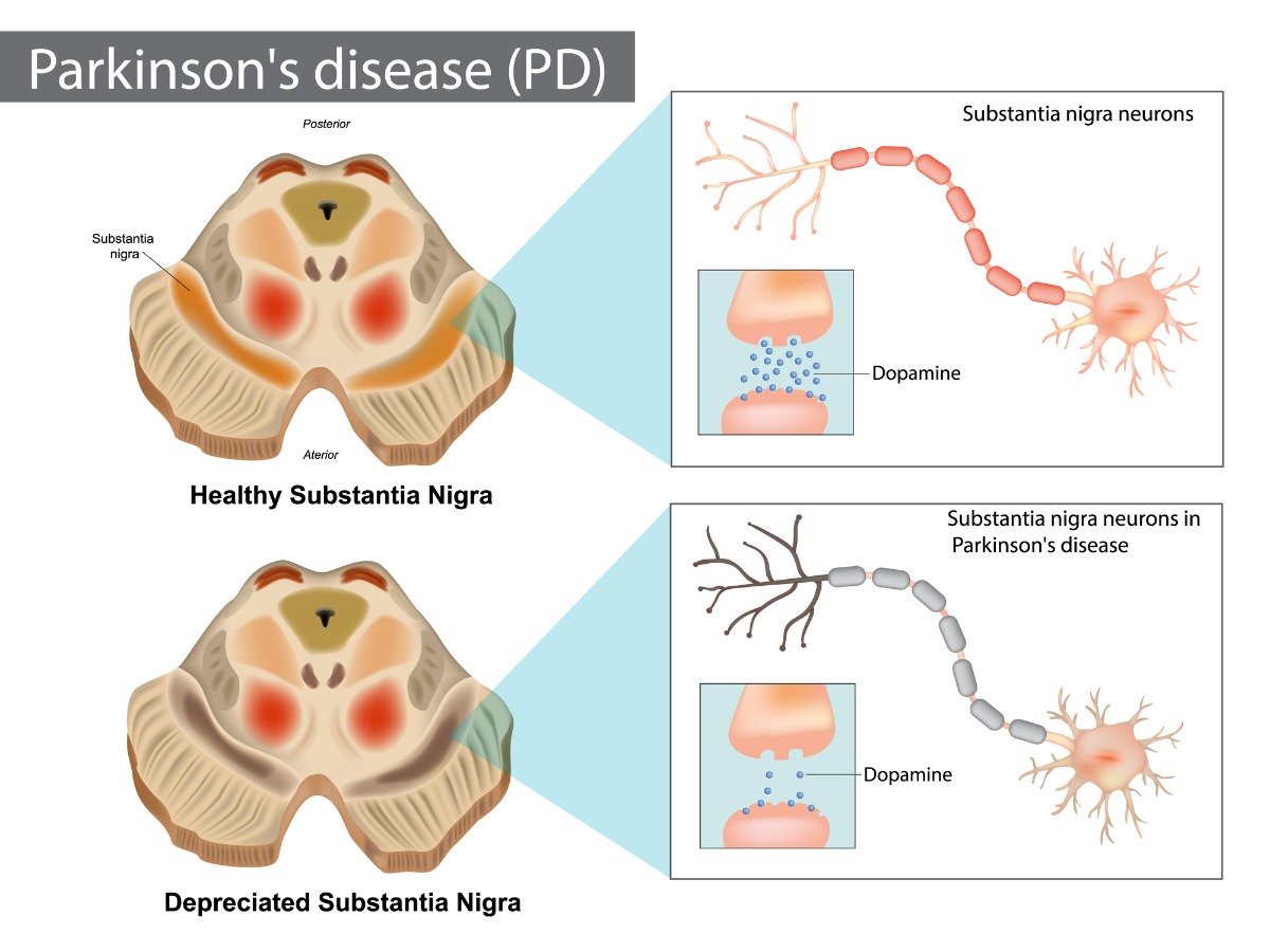 Parkinsons disease human brain